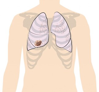 Lung cancer 