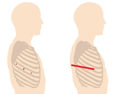 Robotic Lung Surgical Incisions