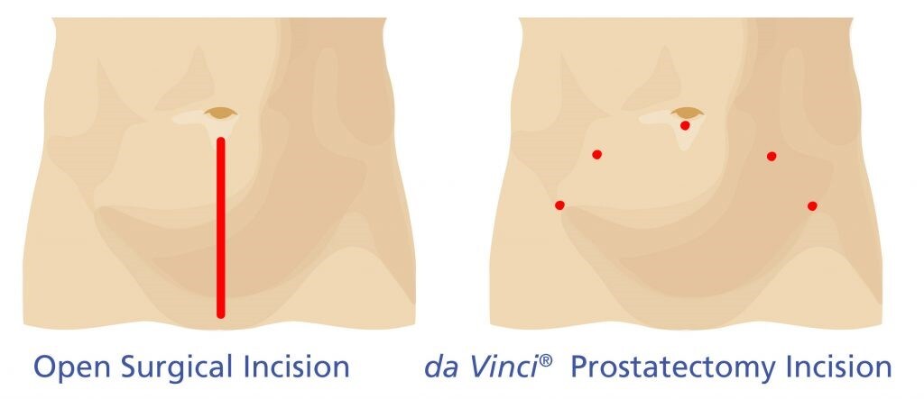 Incision sites for prostate cancer surgery