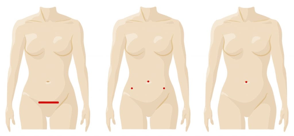 Benign_hyst_incision_comparisons_open_lap_Single-Site