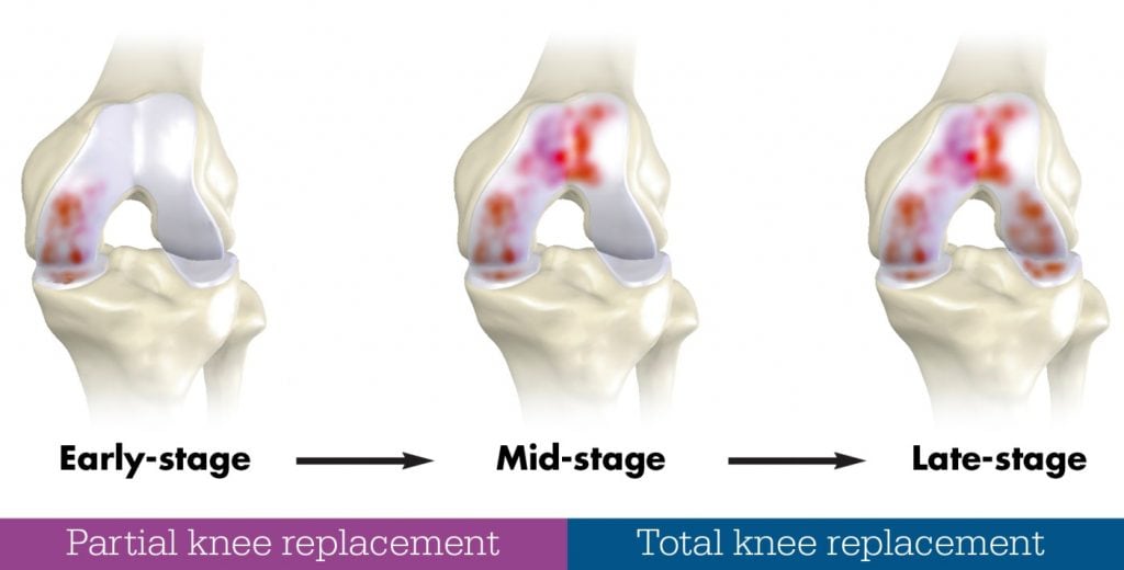 Knee Replacement Graphic