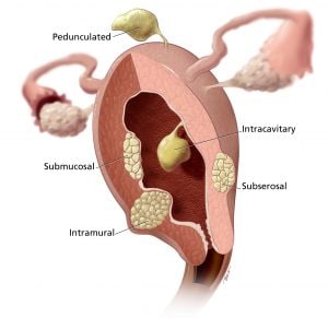 Uterine Cutaway Fibroids