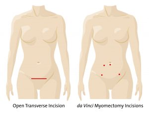 Incision Comparison Myomectomy