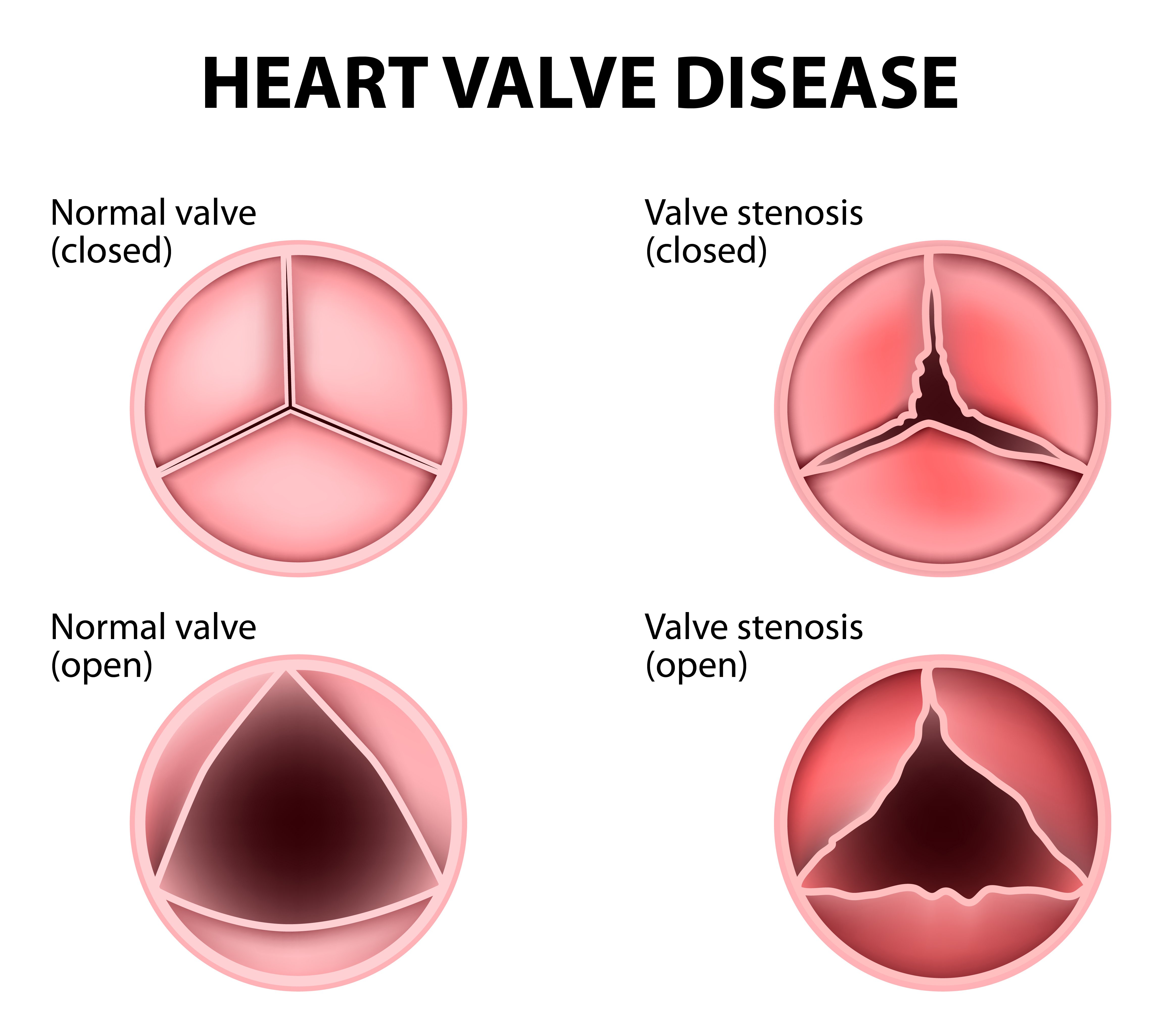 Heart Valve Disease