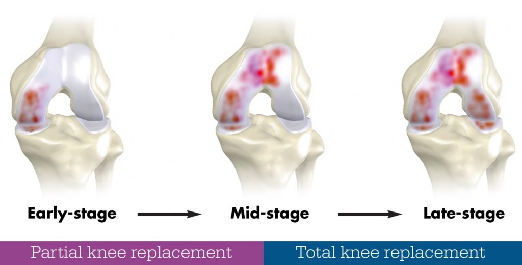 Knee Replacement