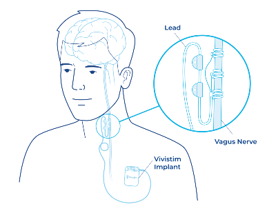 Vivistim Paired VNS System Implant Diagram