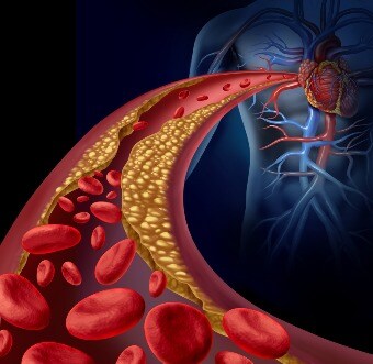 Heart Artery Plaque